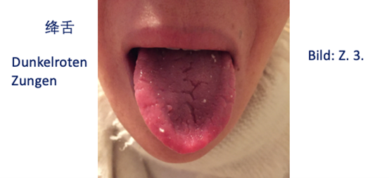 Zungendiagnostik
